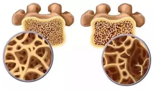 骨化三醇与阿法骨化醇有何不同？