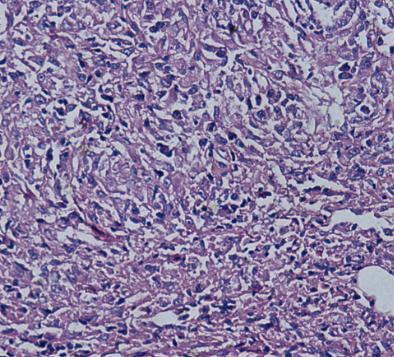 人神经上皮瘤细胞