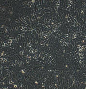 人眼脉络黑色素瘤细胞.png 人眼脉络黑色素瘤细胞.png