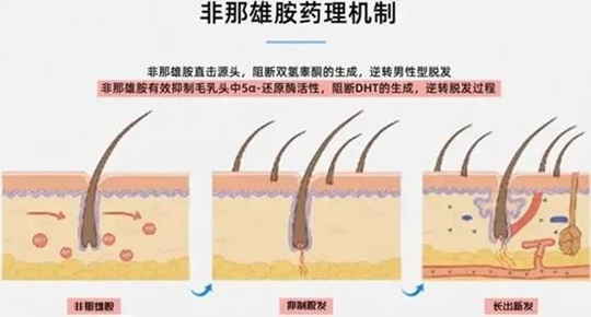 非那雄胺治疗脱发的药理机制 非那雄胺治疗脱发的药理机制