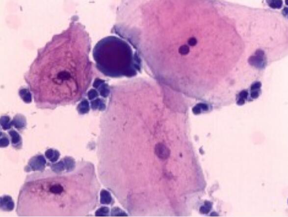 A2（人腺样囊性癌细胞）