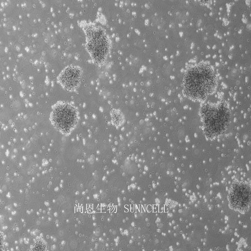 人恶性非霍奇金淋巴瘤患者NK细胞