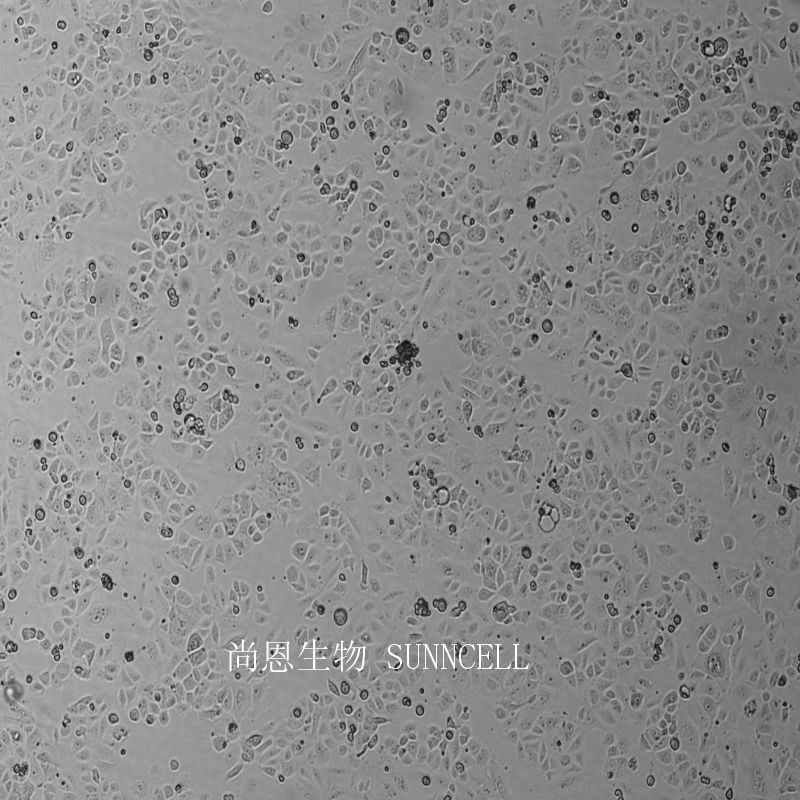 人肝癌亚力山大细胞