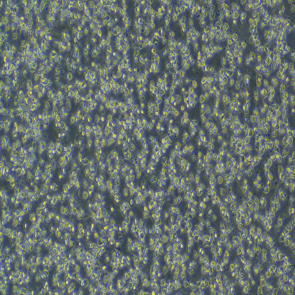 Humanuvealmelanoma