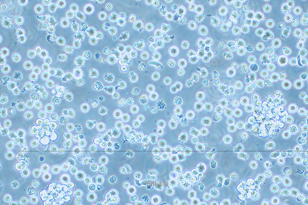 人恶性非霍奇金淋巴瘤患者的自然杀伤细胞NK92(STR鉴定) | EnkiLife恩玑生命