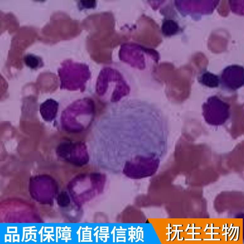 人淋巴母细胞瘤(EBV转化)；NCIBL2009